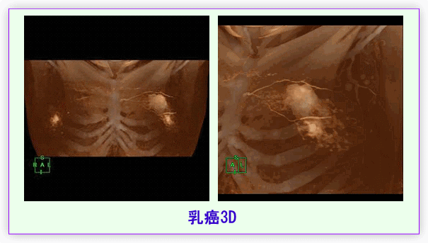 乳がん3D画像