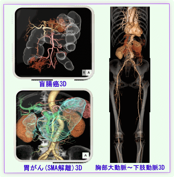 盲腸ガン・胸部大動脈～下肢・胃がん3D画像