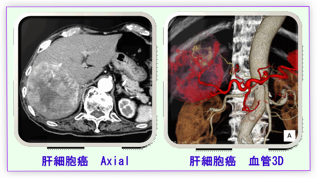 肝がん細胞3D画像