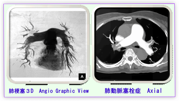 肺動脈塞栓症の画像