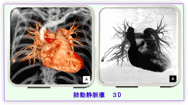 肺動静脈瘻の画像