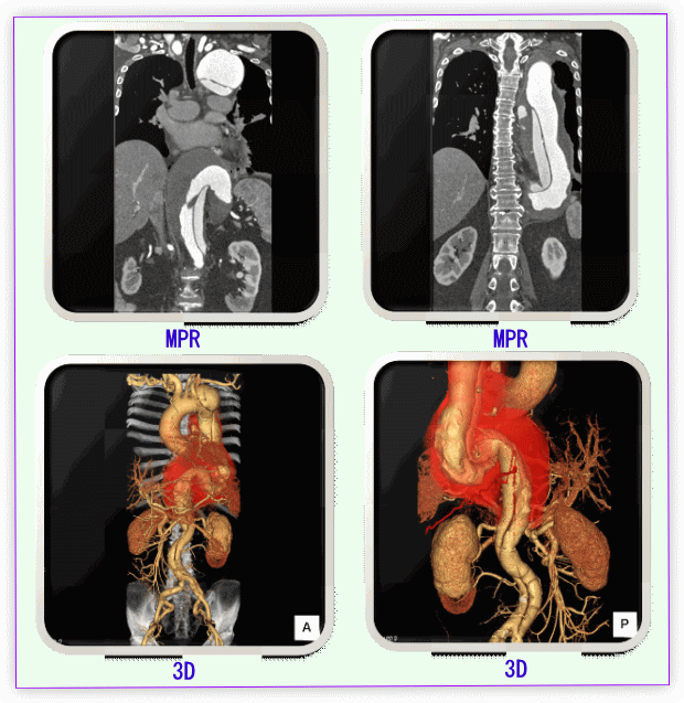 解離性大動脈瘤の画像