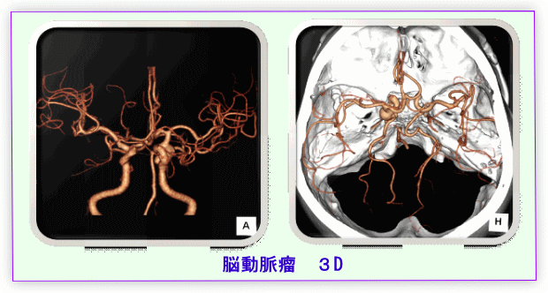 脳動脈瘤の画像