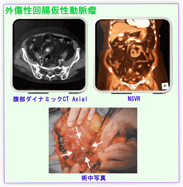 外傷性回腸仮称性動脈瘤の画像