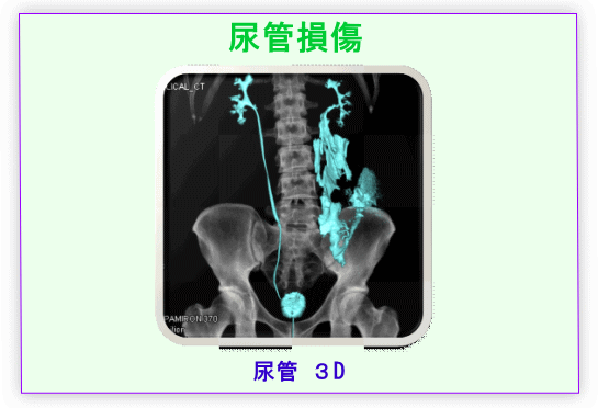 尿管損傷の画像