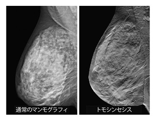 通常のマンモグラフィの画像とトモシンセシス画像の比較画像