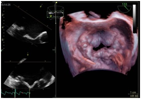 経食道心臓超音波　検査の画像