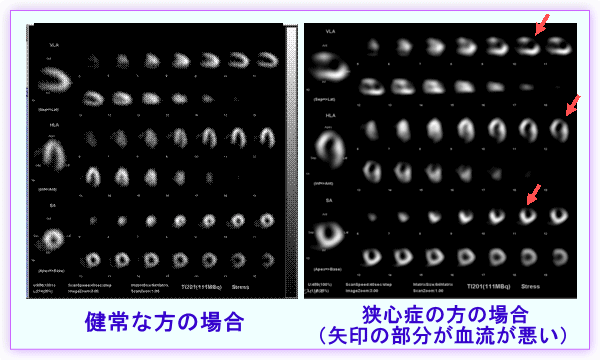 心筋血流検査の画像