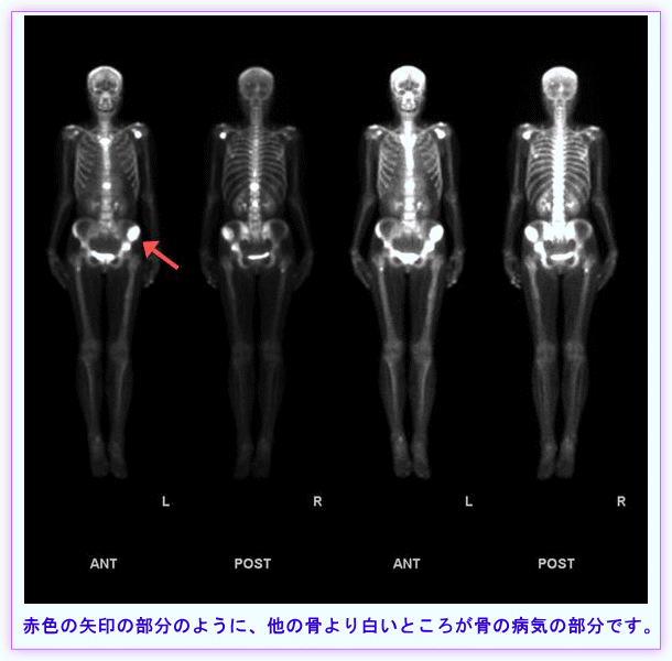 骨の検査の写真