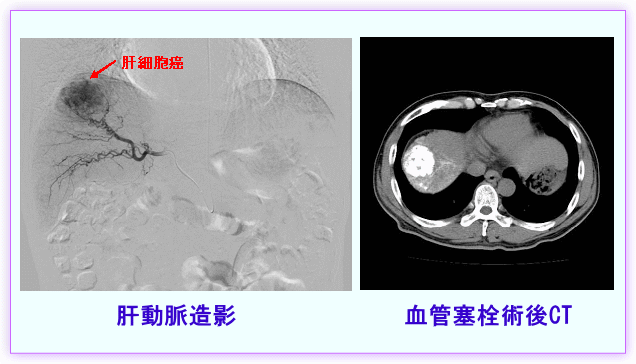 肝動脈造影／血管塞栓術後CT