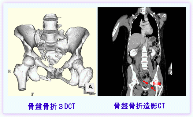 骨盤骨折3DCT／骨盤骨折造影CT