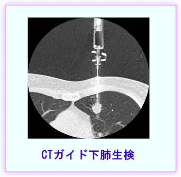 CTガイド下肺生検
