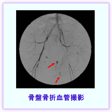 骨盤骨折血管撮影