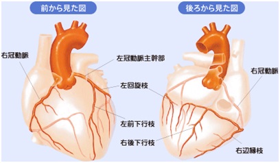 心筋梗塞