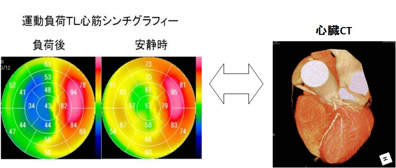 心筋梗塞狭心症などの虚血性心疾患の図2