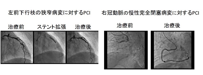 心筋梗塞狭心症などの虚血性心疾患の図3