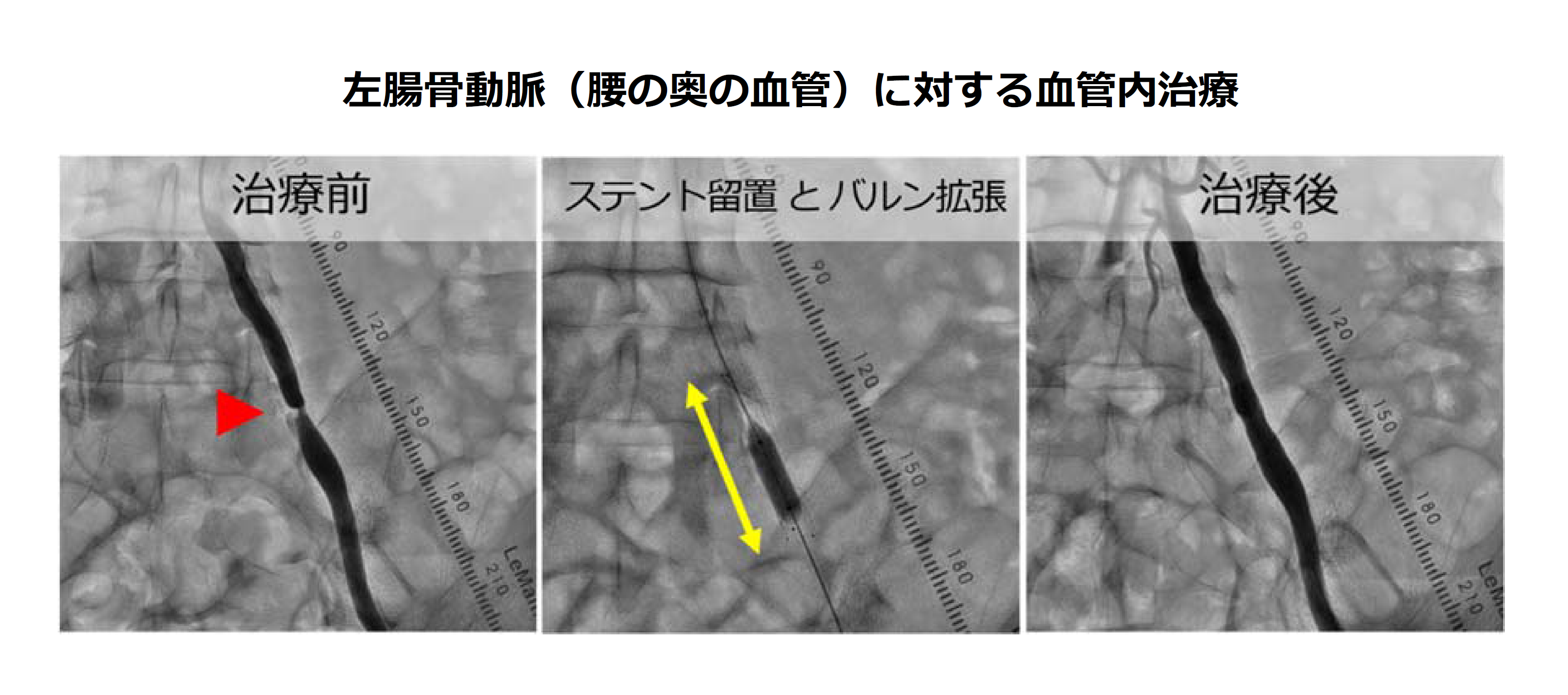 血管内治療