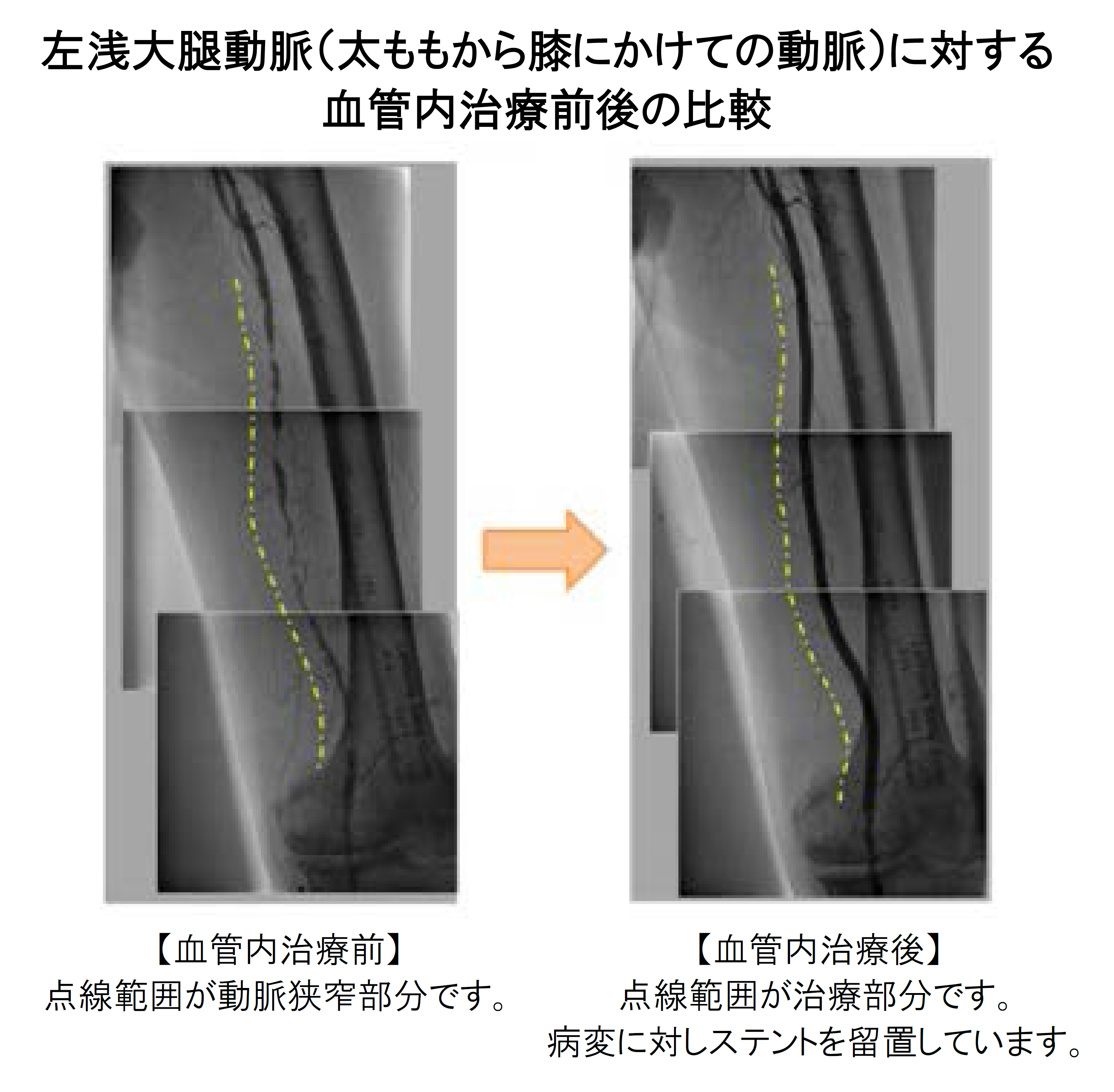 血管内治療前後