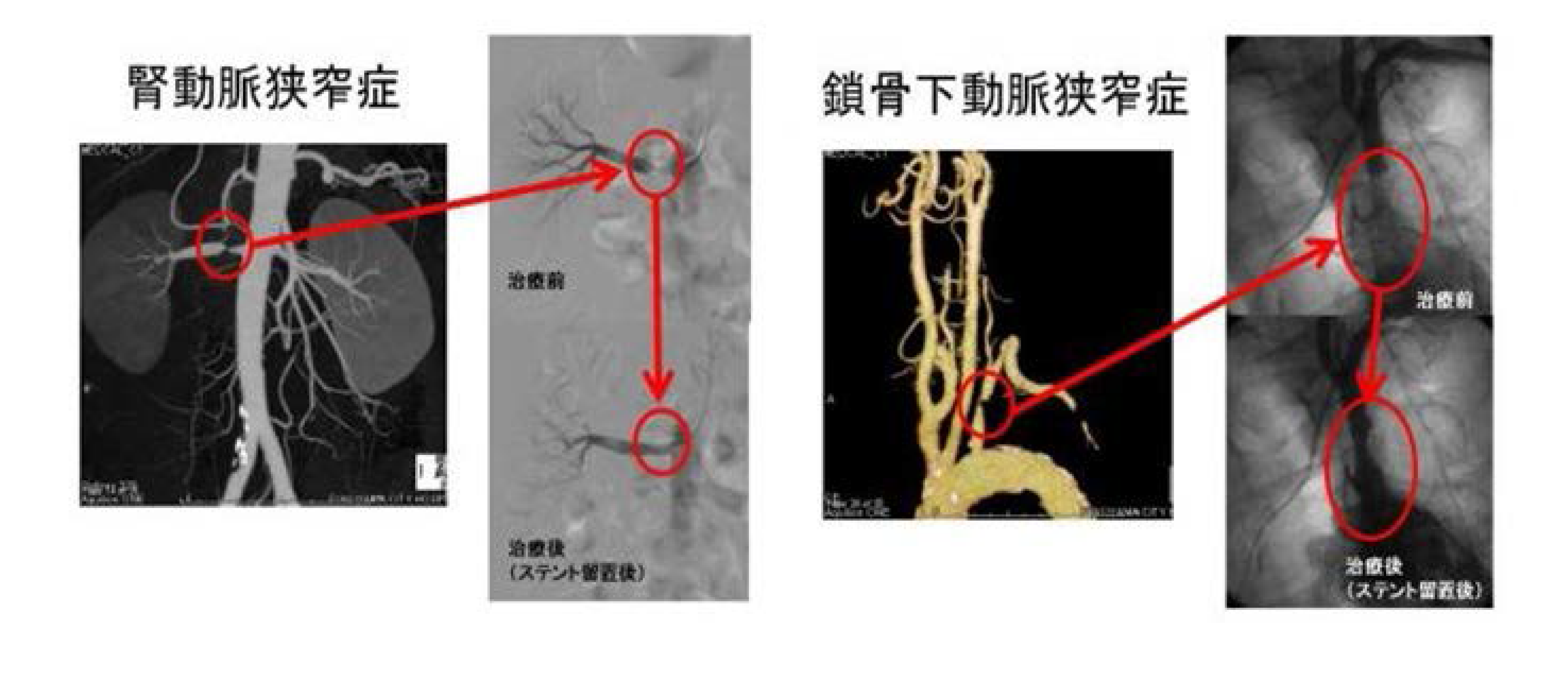 狭窄症の図