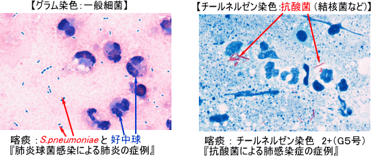 グラム染色とチールネルゼン染色