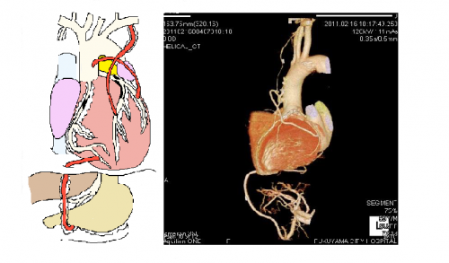 冠動脈バイパス術の画像