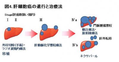 図4.肝細胞癌の進行と治療法