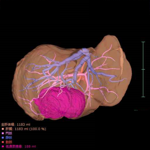 撮影したCT情報から肝臓の3D解析の画像1