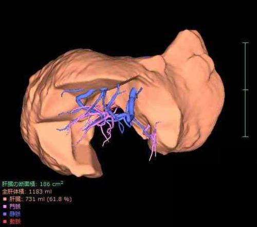 撮影したCT情報から肝臓の3D解析の画像2