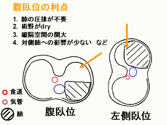 腹臥位の利点について説明図