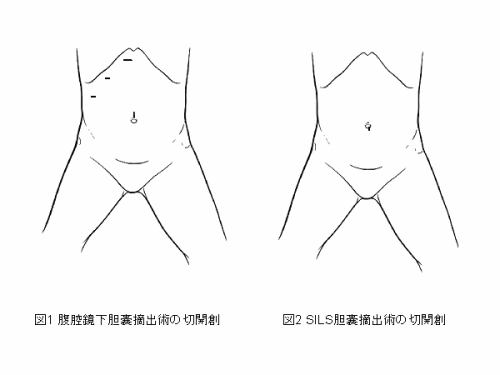 SILSによる腹腔鏡下胆嚢摘出術についてのイラスト・写真