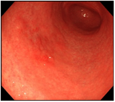 胃ESDの手技の流れ手順1の画像