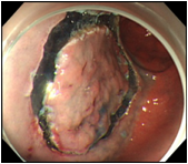 胃ESDの手技の流れ手順4の画像