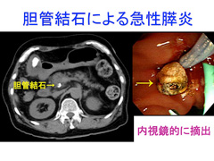 胆管結石による急性膵炎