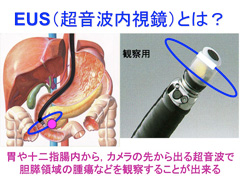 EUS（超音波内視鏡）とは？