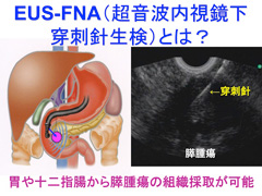 EUS-FNA（超音波内視鏡穿刺針生検）とは？の画像