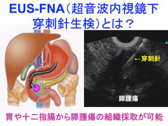 EUS-FNA（超音波内視鏡穿刺針生検）とは？の画像