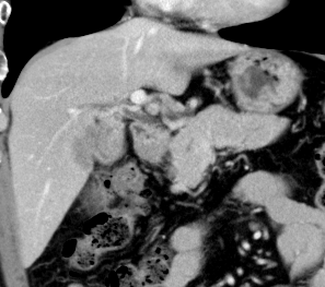 胆嚢癌肝門浸潤症例の画像