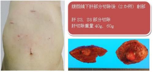 腹腔鏡下肝部分切除後腹部の写真と肝切除の写真