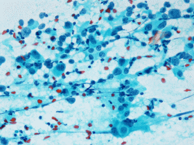 細胞診標本（パパニコロー染色)