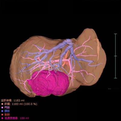 肝がん3D画像1