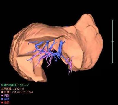 肝がん3D画像2