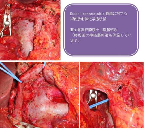 Borderline resectable膵癌　術前放射線化学療法後切除症例　予後の画像