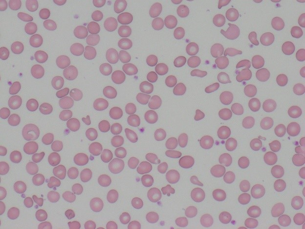 貧血のある赤血球（低色素）の画像