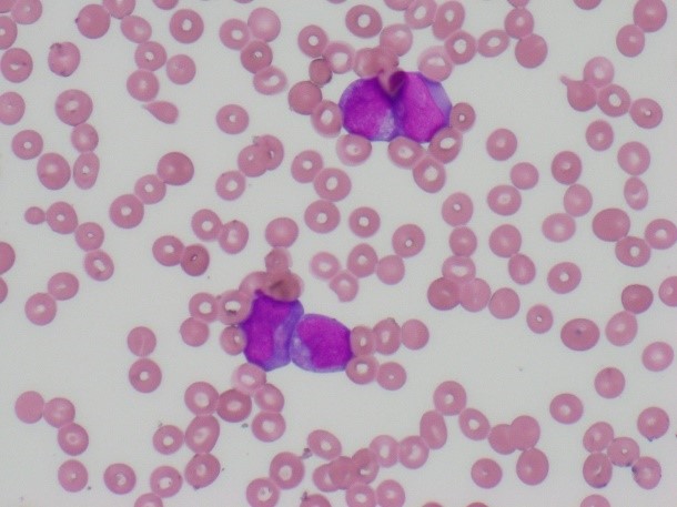 異常な白血球の画像