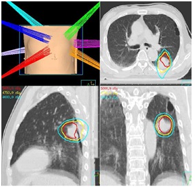 肺定位照射（例1）の画像
