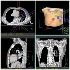 肺定位照射（例2）の画像