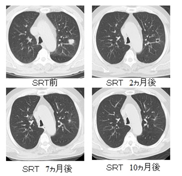 肺定位照射治療経過の画像