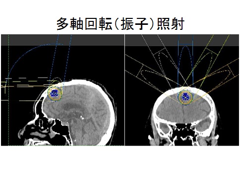 多軸回転（振子）照射