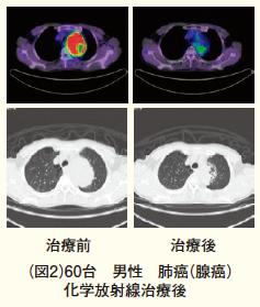 肺がん化学放射線治療前後の画像（図2）
