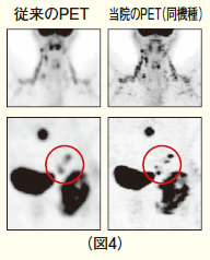 PET／CTのPETカメラは散乱線の影響を抑え、より正確、高品質の画像を撮影できます（図4）。